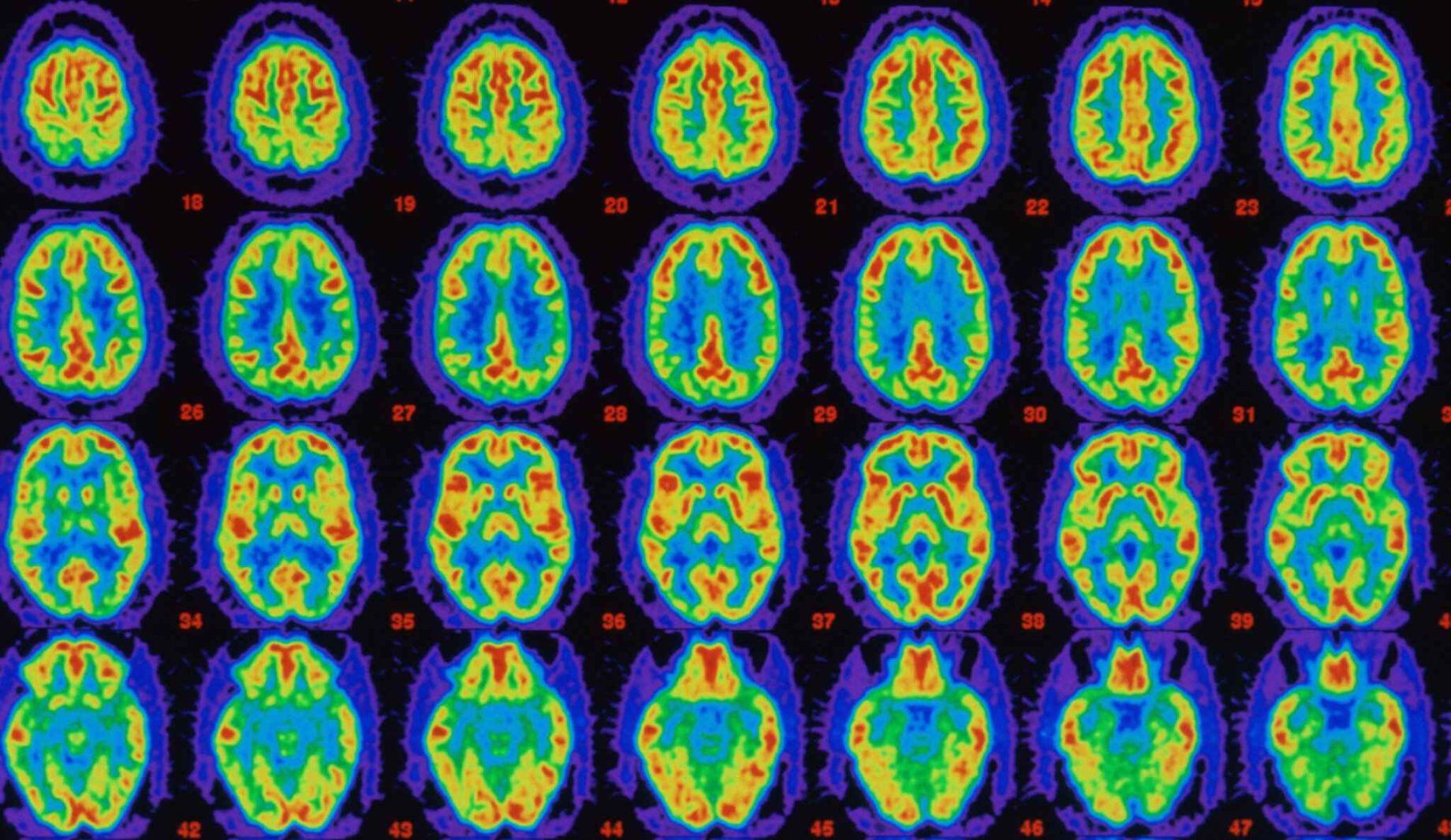 menopause fuels brain patterns seen in alzheimer's