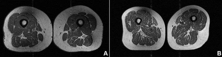 ultra processed diets