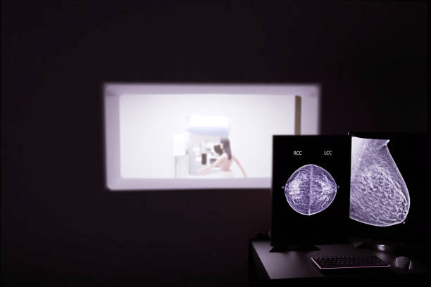 ai assisted breast screening to catch cancers earlier